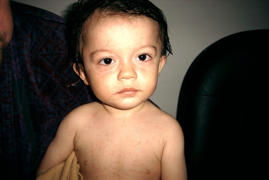 heat rashes on babies. heat rash on baby face.